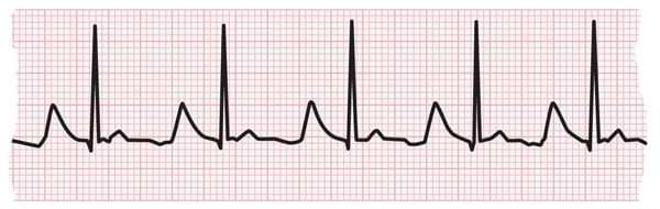 ECG strip showing normal heartbeat