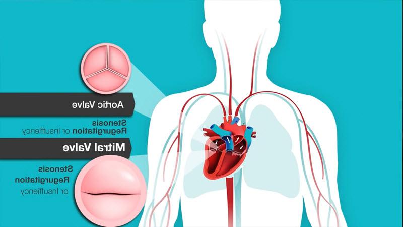 Understanding Heart Murmurs, Aortic and Mitral Valve Problems video screenshot